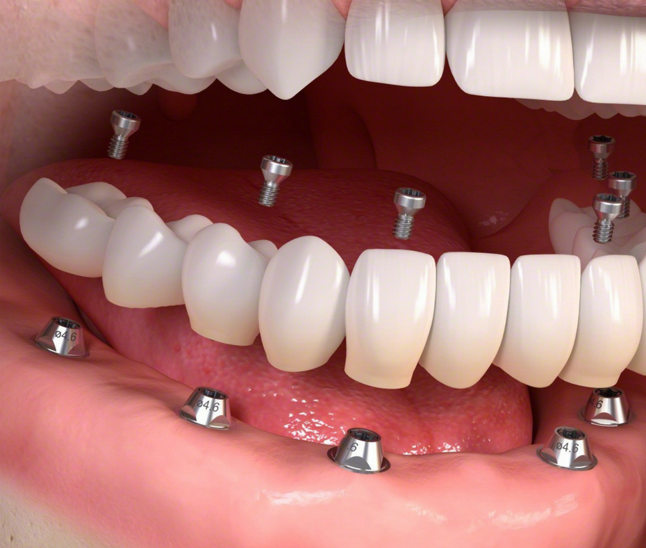 שיקום לסת שלמה - השתלות שיניים
